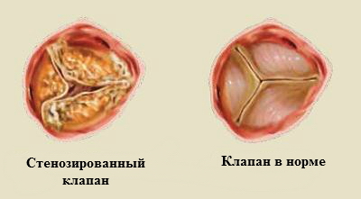 стеноз клапанов сердца